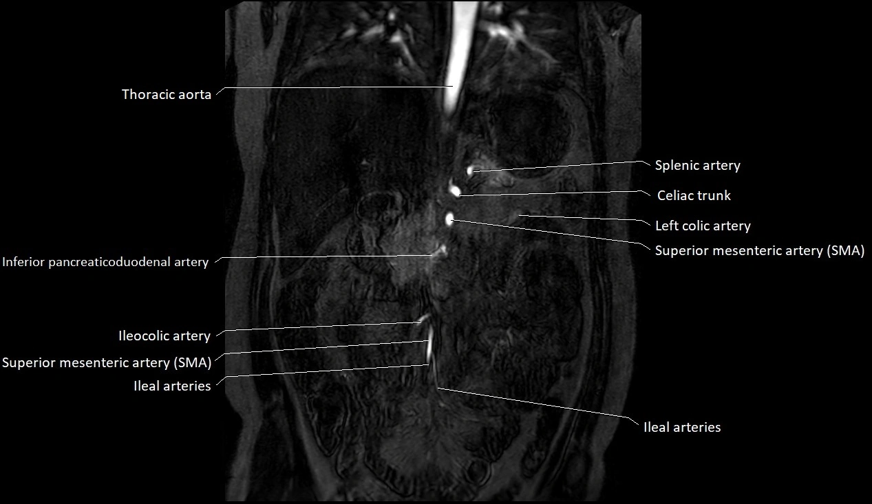 MRA Abdomen coronal anatomy image 12.webp